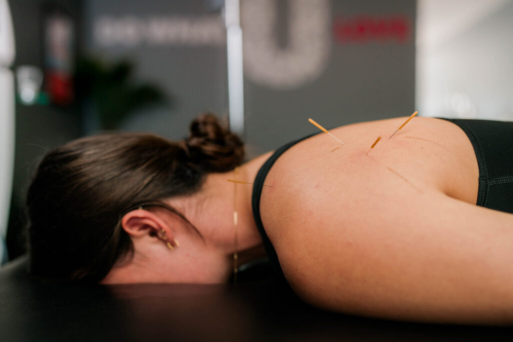 Woman having an Acupuncture session laying on massage bed.