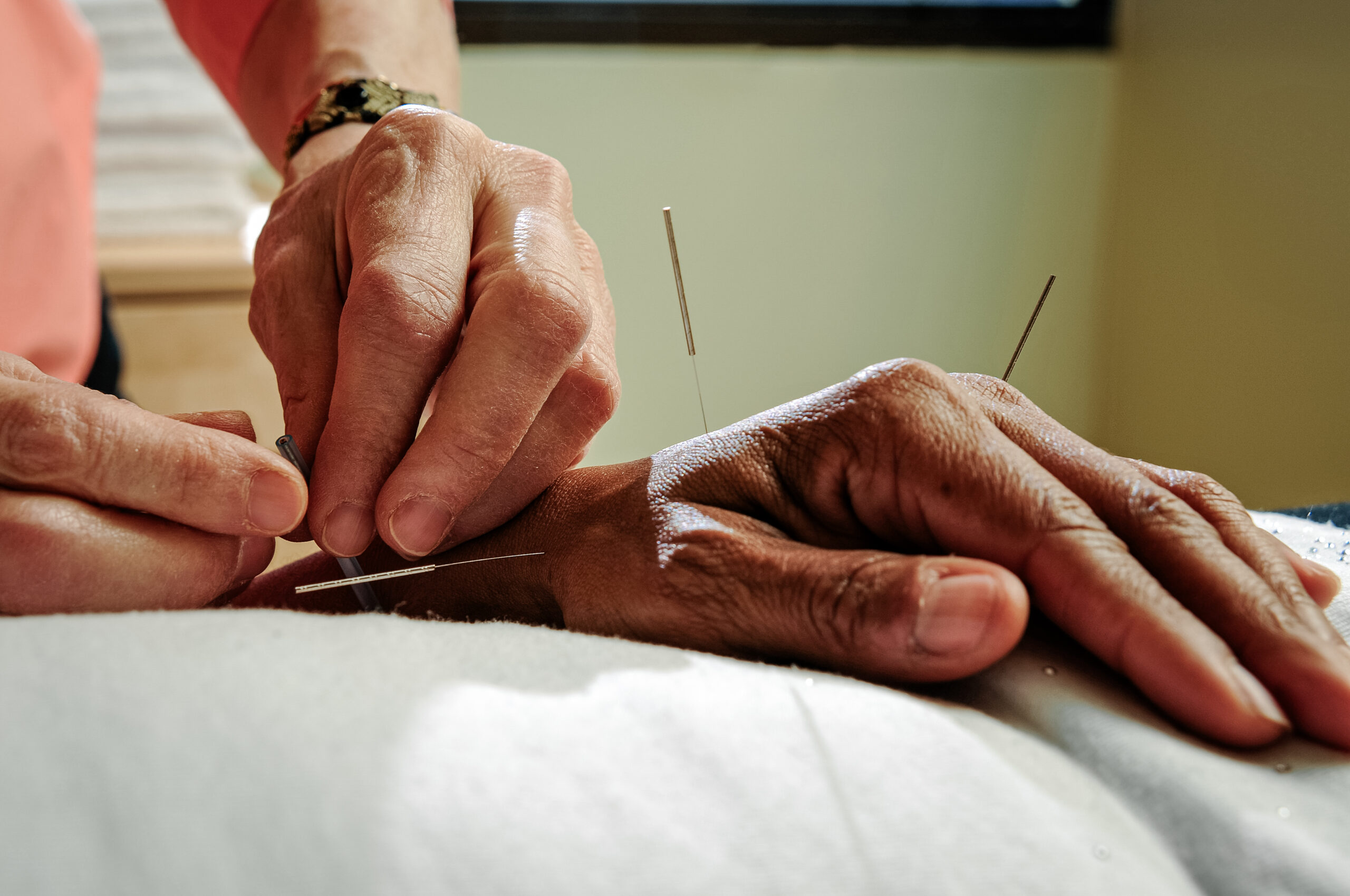 Acupuncture on patient hand. Professional adding needles.