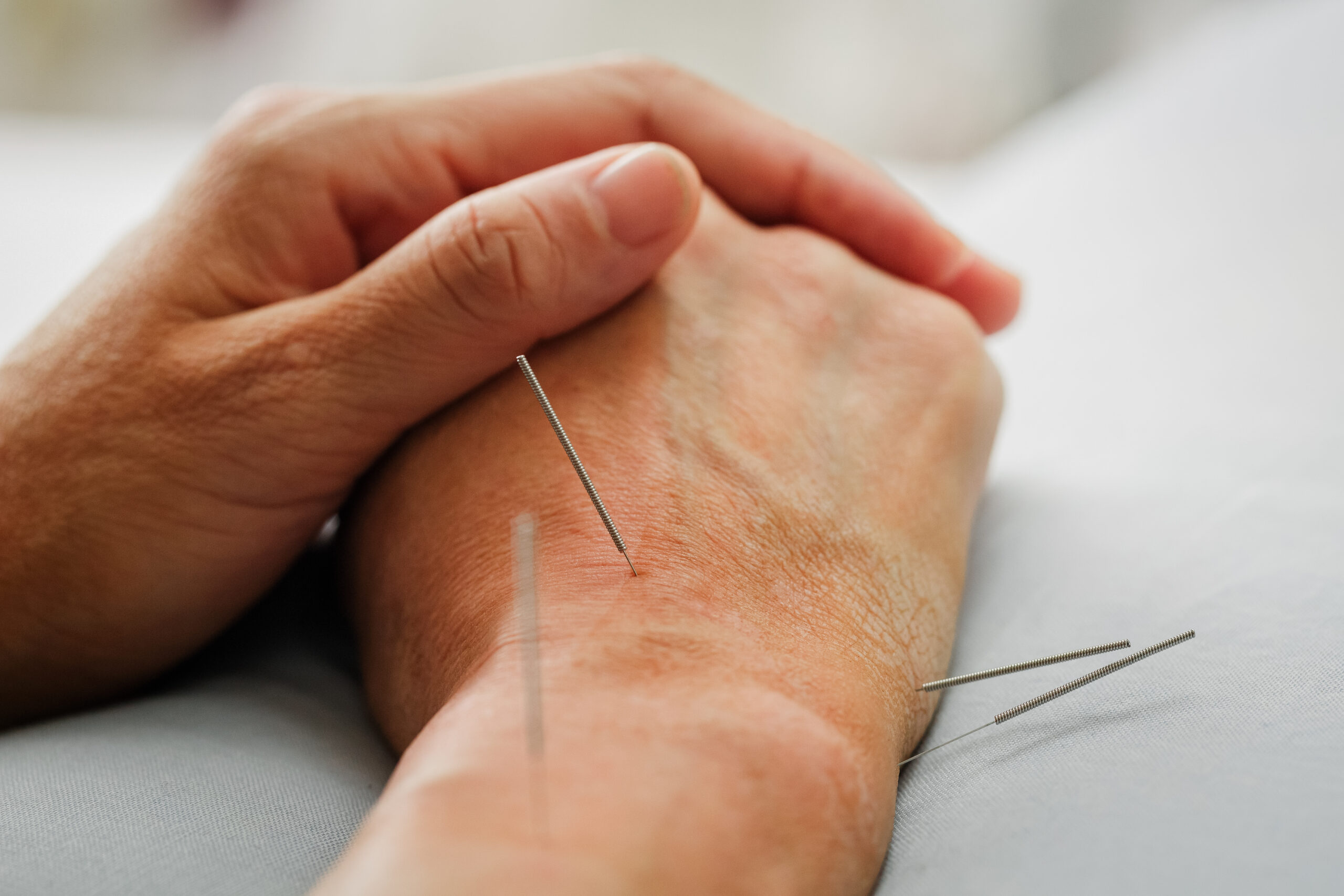 The patient had a lot of acupuncture on his hand