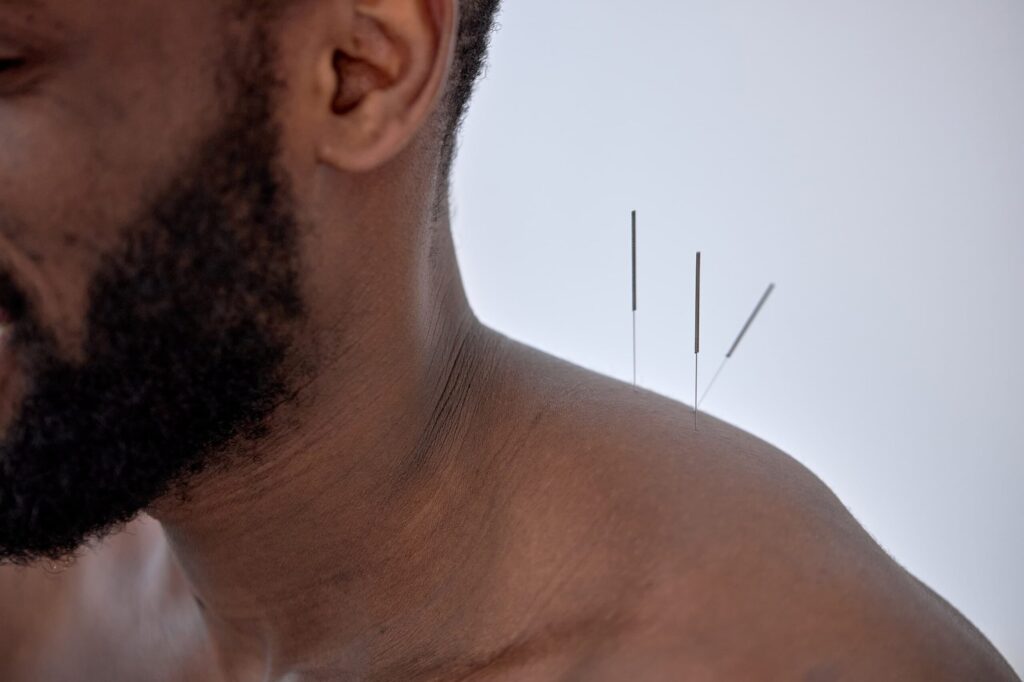 Close up of acupuncture needles placed in a patient's upper shoulder.