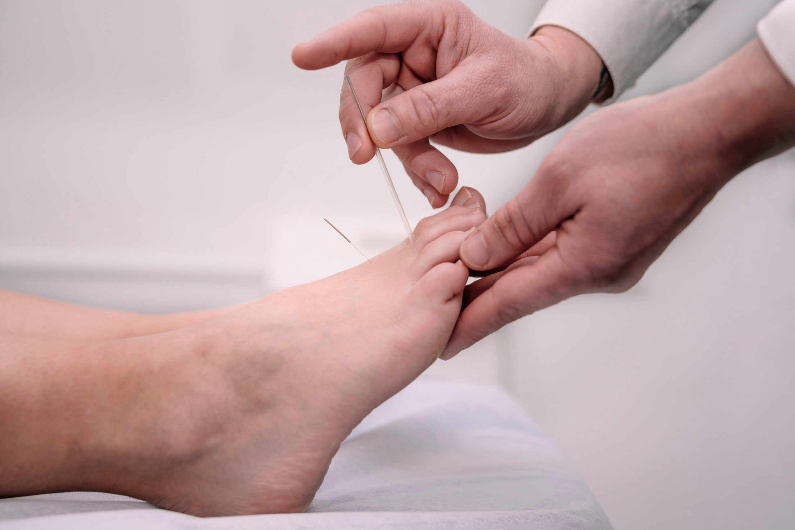 Close-up of hands placing acupuncture needles in patient's foot session.