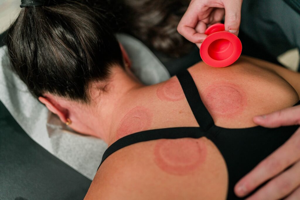 Cupping results on female patient back.