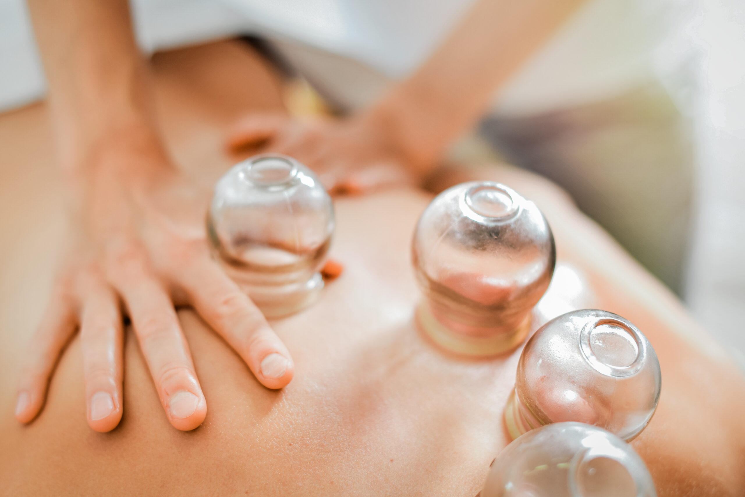 Detail of a woman therapist hands giving cupping treatment on back.