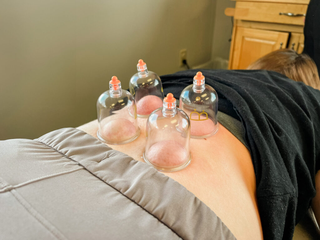 Transparent cups being used in a cupping session on patient back.