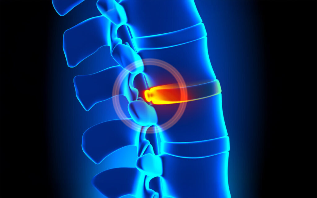 3d illustration of a bulging disc between vertebrae.