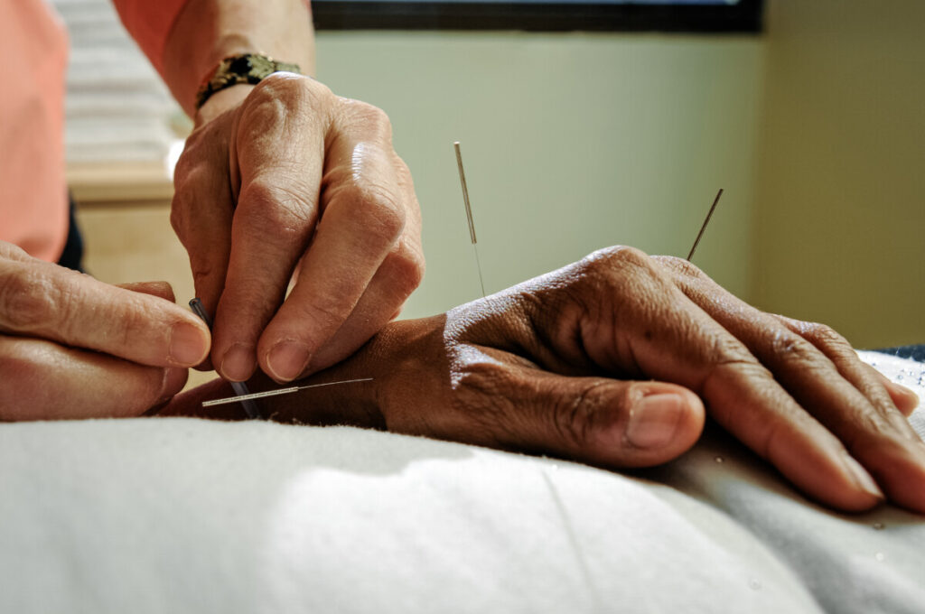 Practitioner places dry needles into patient's hand