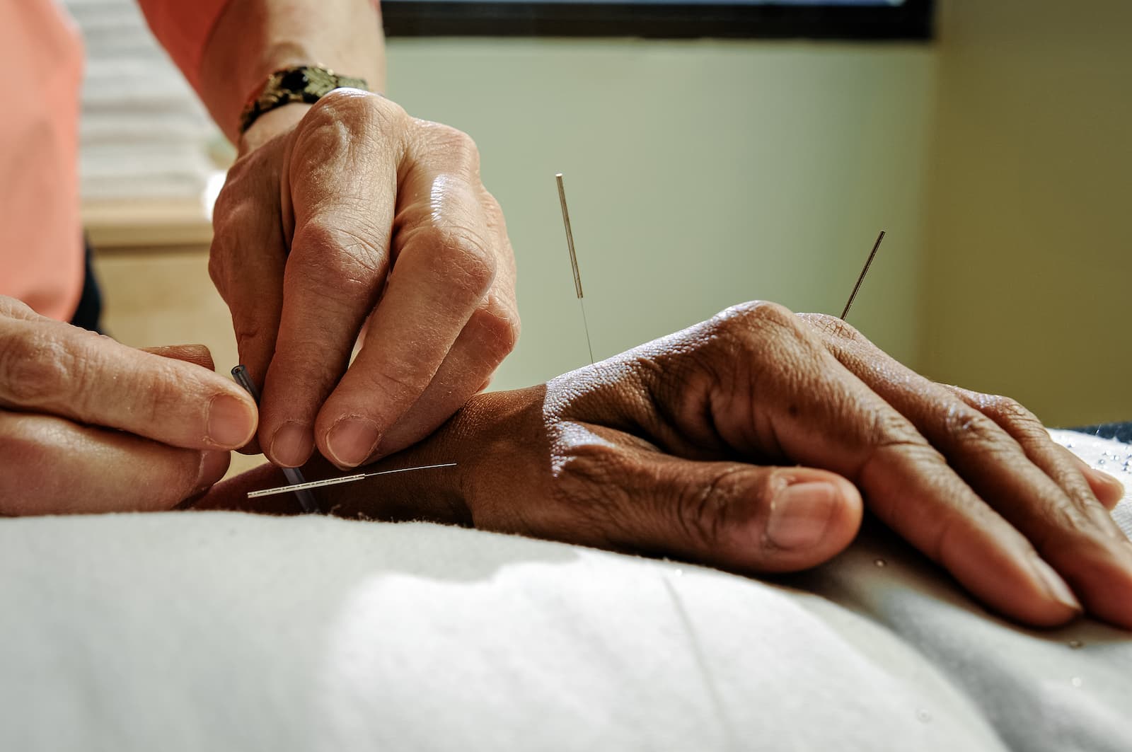 Close up of practitioner carefully placing acupuncture needles in a patient's hand. 