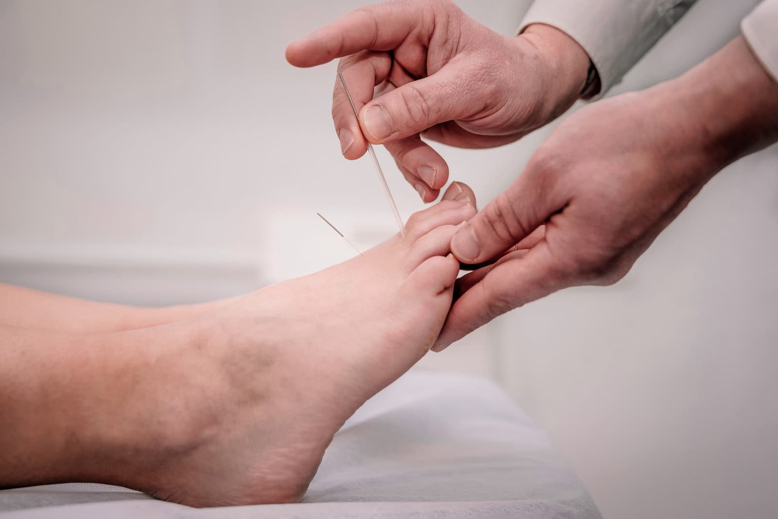 Close up of practitioner carefully placing acupuncture needles into a patient's foot. 