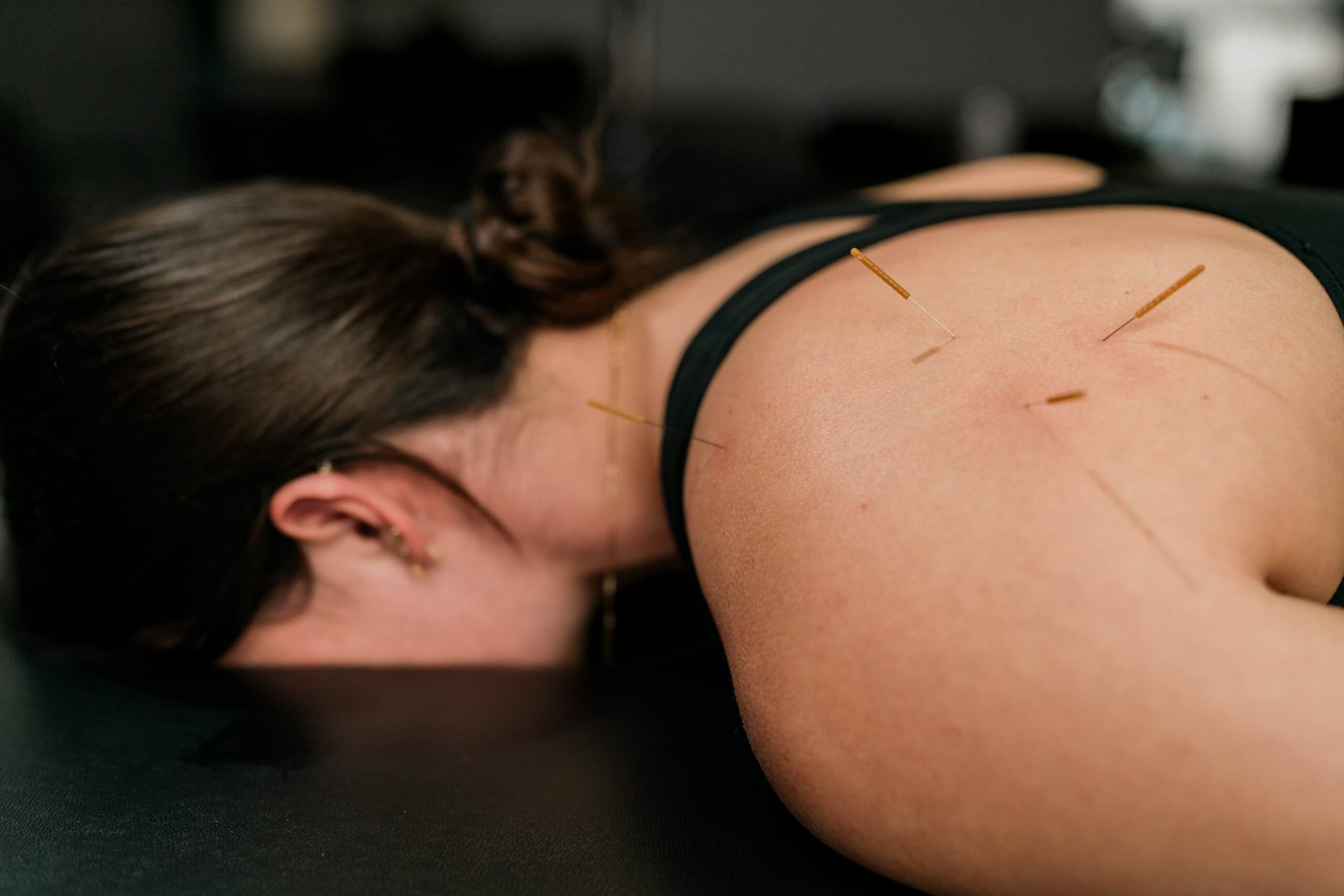 Patient laying facedown on table with acupuncture needles placed in their shoulder. 